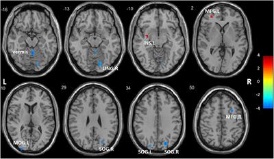 Altered regional homogeneity and functional connectivity of brain activity in young HIV-infected patients with asymptomatic neurocognitive impairment